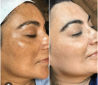 Hyperpigmentation treatment